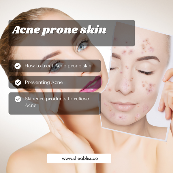 Acne Prone Skin.. How to treat and care for your skin